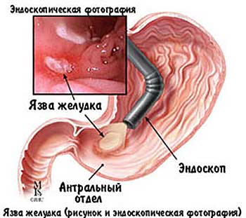 Гастродуоденоскопия - что это, как делается, сколько стоит, как готовиться? Гастродуоденоскопия - что это, как делается, сколько стоит, как готовиться?